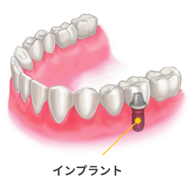 インプラント