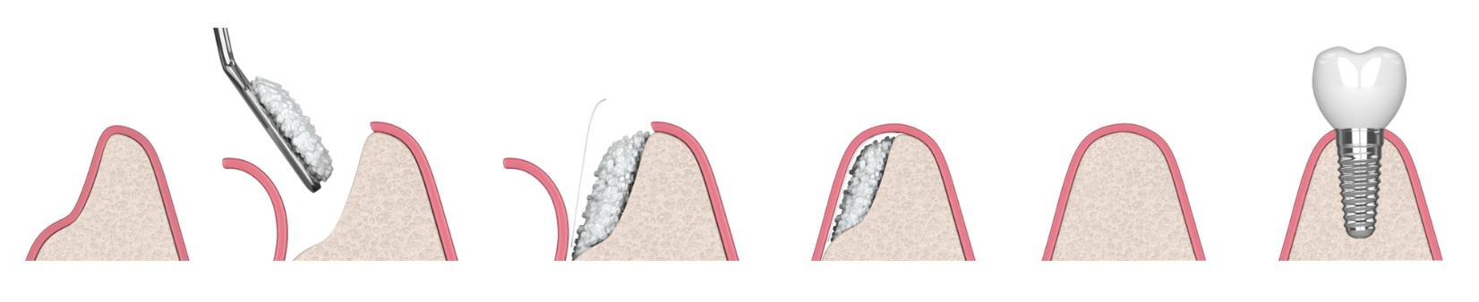 GBR(骨再生誘導法) Guided Bone Regeneration